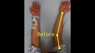 Elbow valgus deformitycubitus valgus surgery by Dr Ahn [upl. by Intyrb]