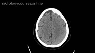 Isodense subdural haemorrhage SDH [upl. by Eehtomit]