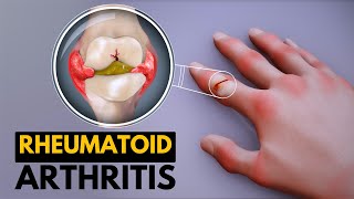 Rheumatoid Arthritis Causes Signs and Symptoms Diagnosis and Treatment [upl. by Inasah]