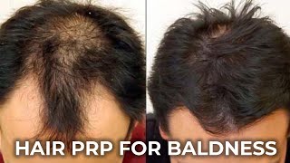 Hair Fall Treatment Hair PRP Treatment  بالوں کے جھڑنے اور ہیئر لائن کے پیچھے ہٹنے کا علاج [upl. by Cressler]