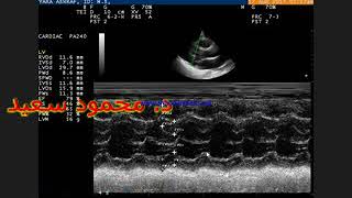 LV SYSTOLIC FUNCTION [upl. by Checani]