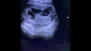 Triplet viable intrauterine gestation ultrasound shorts pregnancyscan [upl. by Adnahsed998]