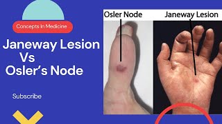 Janeway Lesions Vs Oslers Nodes Simplified Approach [upl. by Nhtanhoj]