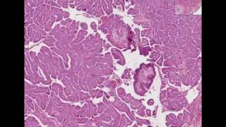 Histopathology Thyroid Papillary carcinoma [upl. by Lon927]