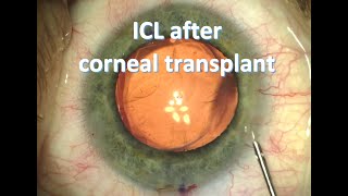 Implantable contact lens ICL after corneal transplant [upl. by Halie]