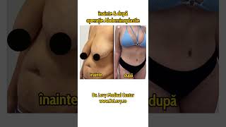 Înainte și după operație de Abdominoplastie  exces de piele abdomen  La Doctor Levy România [upl. by Miru730]