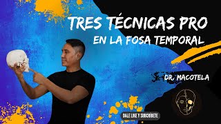 TRES TÉCNICAS PRO EN FOSA TEMPORAL [upl. by Arimlede]