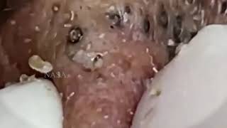 blackheads new 2023 today  blackheads  blackheads new2024 this week blackheads removal [upl. by Nikolaos]