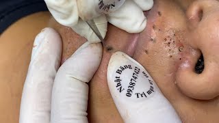 Big Cystic Acne Blackheads Extraction Blackheads amp Milia Whiteheads Removal Pimple Popping  9188 [upl. by Leur]