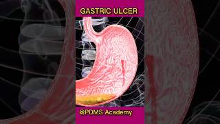 Gastric Ulcer  causes and treatment medicine healthcare [upl. by Leinod]