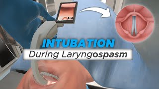 Intubation during Laryngospasm [upl. by Esnahc]