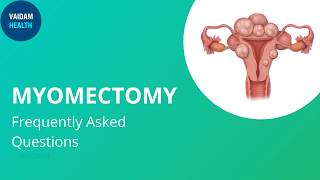 Myomectomy Frequently Asked Questions [upl. by Anaed99]