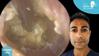 1096  Complex Swollen amp Infected Ear Wax Removal [upl. by Adian605]