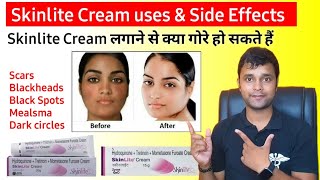 skinlite cream side effects skinlite cream [upl. by Bryanty]