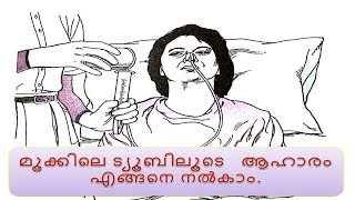 RYLES TUBE FEEDING Malayalam  How to give food through tube malayalam [upl. by Idna]