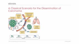 Cancer Epithelial mesenchymal transition in carcinoma 211 [upl. by Herrmann]