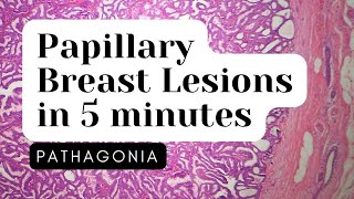 Papillary Neoplasms of Breast 5 Minute Overview pathagonia [upl. by Jeremiah]