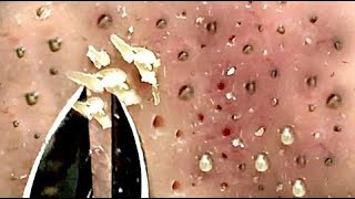 Best Satisfying Nose Plucking Blackheads Whiteheads Removal  Acne Treatment 20 [upl. by Bates]