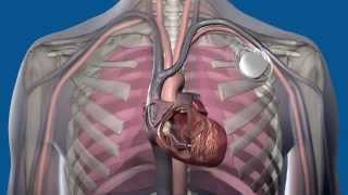 Heart Failure  Clinical Presentation [upl. by Eisor]