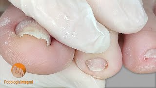 Nail cleaning  trimming podologia asmr [upl. by Niven142]