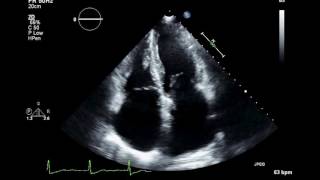 Practice Visual Estimation of Left Ventricular Ejection Fraction Atrial Fibrillation Echocardiogram [upl. by Santoro]