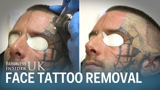 Watch This Man Have His Face Tattoo Removed From Laser Surgery  Business Insider [upl. by Pik541]