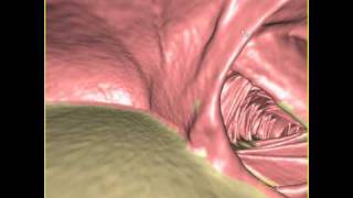 Virtual colonoscopy with retained fluid and stool [upl. by Hart]