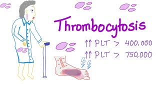 Thrombocytosis Primary and Secondary  Why Is My Platelet Count High  Hematology [upl. by Richela351]