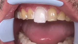 Houston Cosmetic DentistStep by step procedure for Porcelain VeneersConservative preps [upl. by Pelletier]