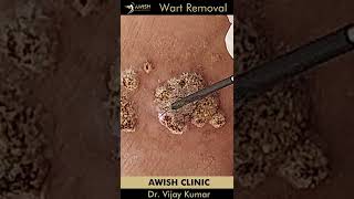 Wart removal treatment  Remove wart permanent  No pain wart remove awishclinic shorts drvijay [upl. by Anik]