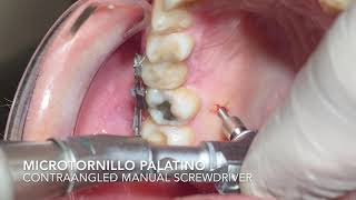 Palatal Miniscrew Placement Inserción Microtornillo Palatino [upl. by Oicneserc]