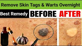 How To Remove Skin Tags And Warts Overnight [upl. by Ayote]