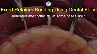 Bonding fixed permanent retainer in orthodontics with dental floss Asker Orthodontics twist flex [upl. by Lemay957]