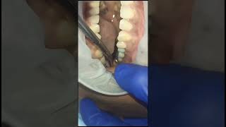 Left upper premolar molar replacement with basal implants and g cam bridge 40 micron clearance test [upl. by Travus]