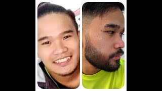 Minoxidil Beard Journey in 3 monthsIntro [upl. by Nonnac385]