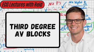 Third Degree AV Blocks  Day 7 ECG Challenge [upl. by Ettevey622]