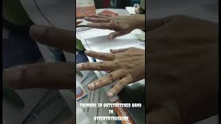 Tremors in outstretched Hand in Hyperthyroidism [upl. by Haon]