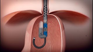 Incisionless Reflux Surgery  EsophyX Transoral Incisionless Fundoplication TIF Procedure [upl. by Irianat501]