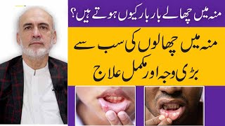 Mouth Blisters CausesSymptoms And Treatment  Muh K Chalon Ka Ilaj In UrduHindi [upl. by Loreen]