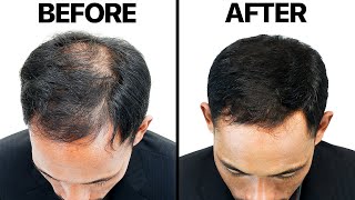 Finasteride Propecia For Hair Loss [upl. by Abraham]