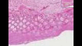 Histopathology Colon Pseudomembranous colitis [upl. by Newra]