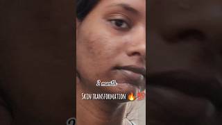 💯🔥 SKIN TRANSFORMATION JOURNEY skintransformation skintransformationjourney skintreatment acne [upl. by Wende850]