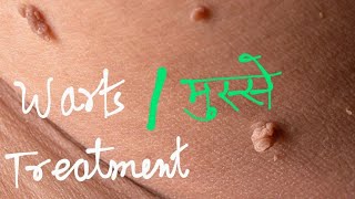 warts  मस्से  permanent treatment [upl. by Sanfred]