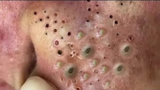 Big Cystic Acne Blackheads Extraction Blackheads amp Milia Whiteheads Removal Pimple Popping  9102 [upl. by Koo]