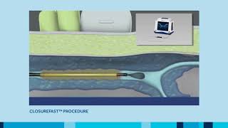 ClosureFast Procedure for Varicose Vein treatment [upl. by Gaither913]