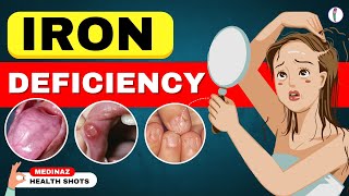 10 Weird Signs Youre Low on Iron  Iron Deficiency Anemia  Iron Deficiency Symptoms [upl. by Flavio383]