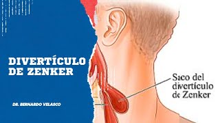 DIVERTICULO DE ZENKER Dificultad para tragar tos crónica rejurgitación de alimentos [upl. by Emmett972]