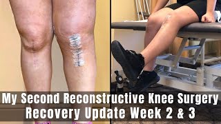 My Second Reconstructive Knee Surgery  Week 2 amp 3 Recovery Update  TTO MPFL amp Lateral Lengthening [upl. by Kravits]