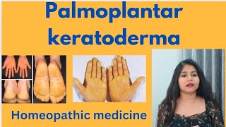 Palmoplantar keratoderma treatment  Palmoplantar keratoderma symptomscauses amp homeopathic medicine [upl. by Gusba]