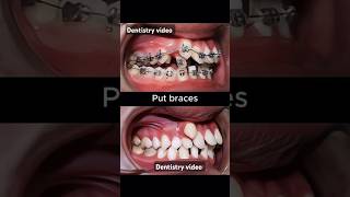 Braces are very crooked teeth braces orthodontist dentistry dentist allaboutbraces [upl. by Eidlog474]